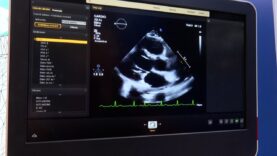 Innovaciones de ecocardiografía basadas en IA se presentan en el SEC
